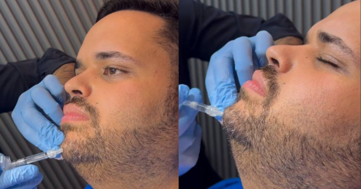 Michel faz harmonização facial com lipo de papada e mostra resultado - Fotos: Instagram