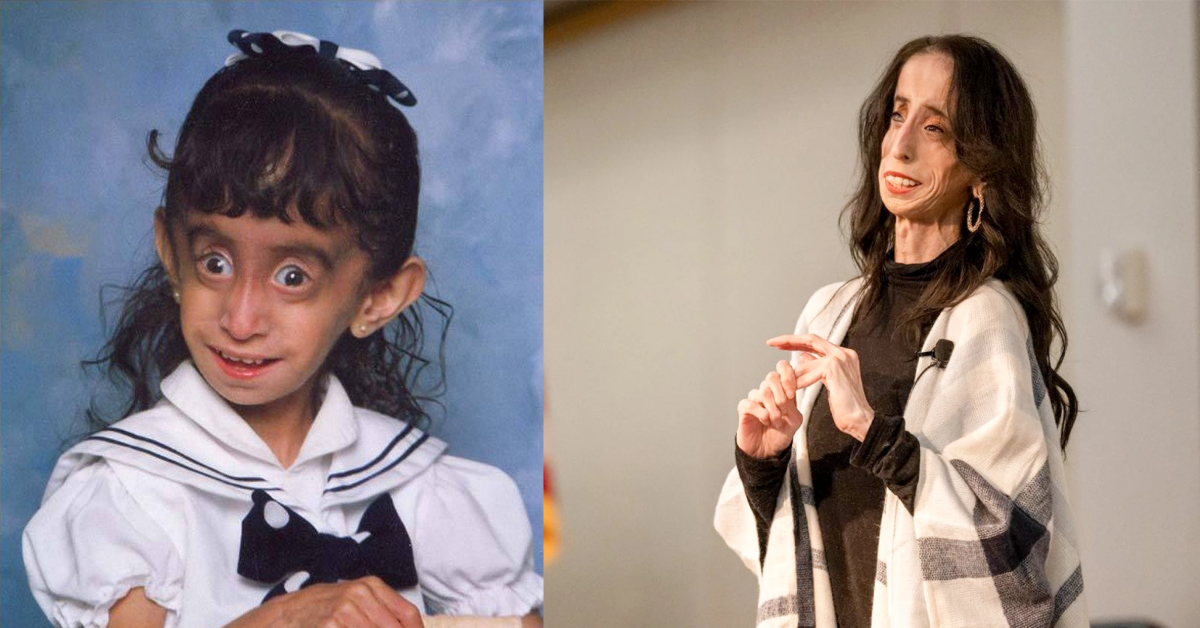Antes e depois da mulher considerada a criança mais feia do mundo - Fotos: Reprodução