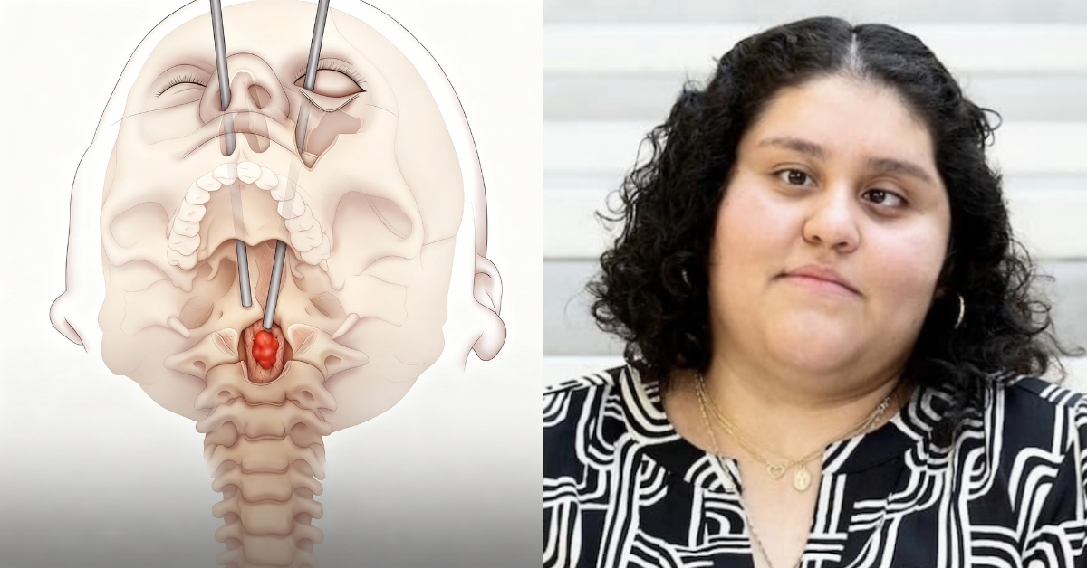 Cirurgia inédita: médicos removem tumor da medula pelo interior da cavidade ocular e abrem nova rota na neurocirurgia